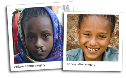 Arfiase, before and after surgery for cleft palate